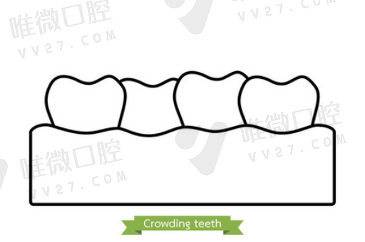 热牙胶连续波充填技术（热牙胶充填时带不出牙胶）(图1)